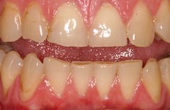 close up of a person's teeth