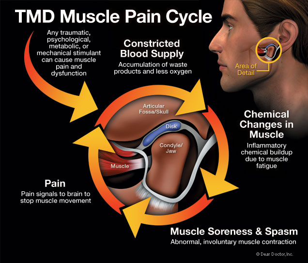 https://www.beaconcovedental.com.au/wp-content/uploads/2020/11/tmd-muscle-pain-cycle-tmj.jpg