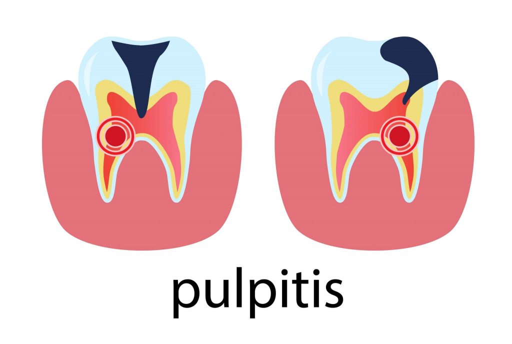 molar pulpitis illustration