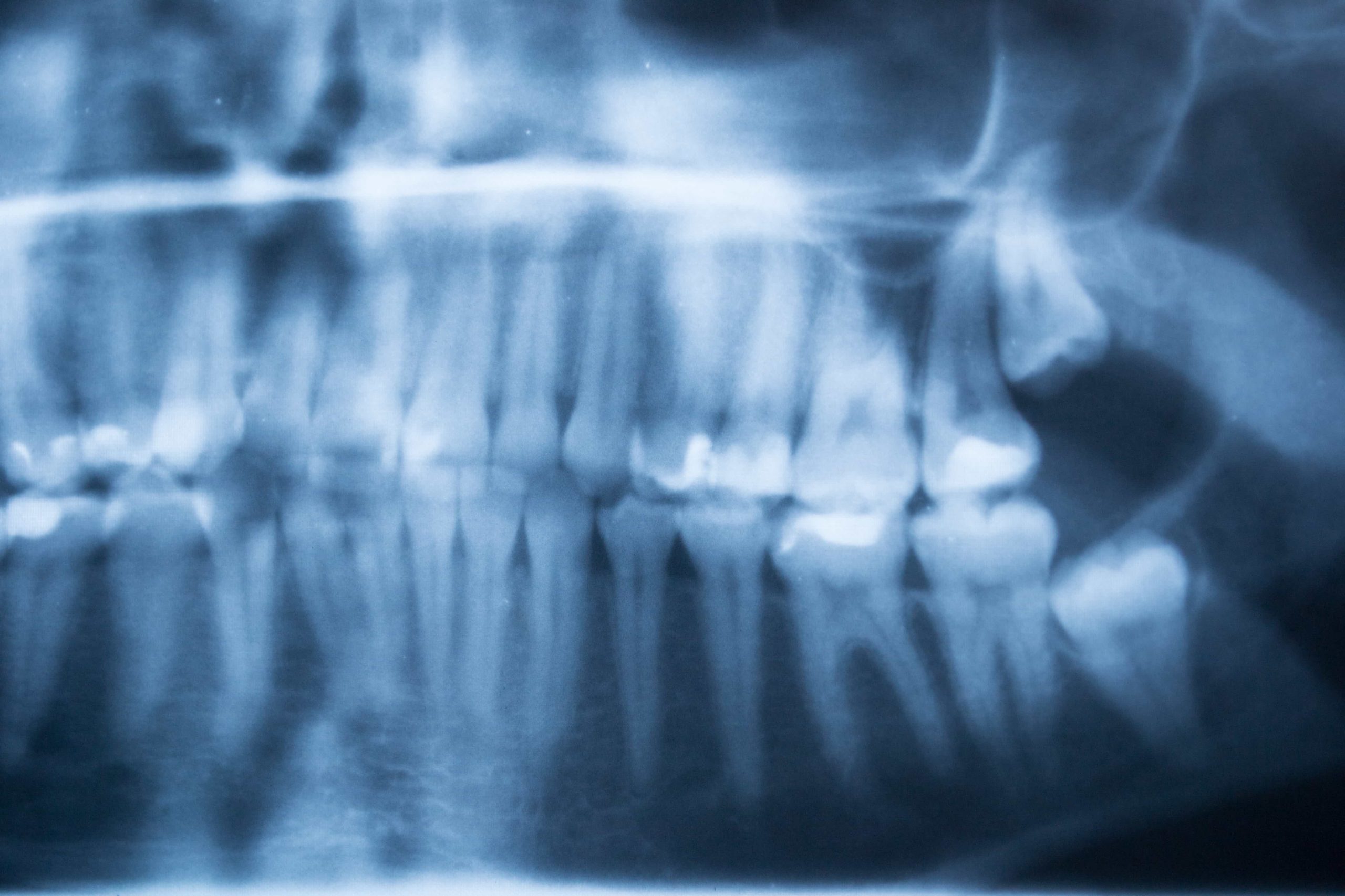 panoramic dental x ray