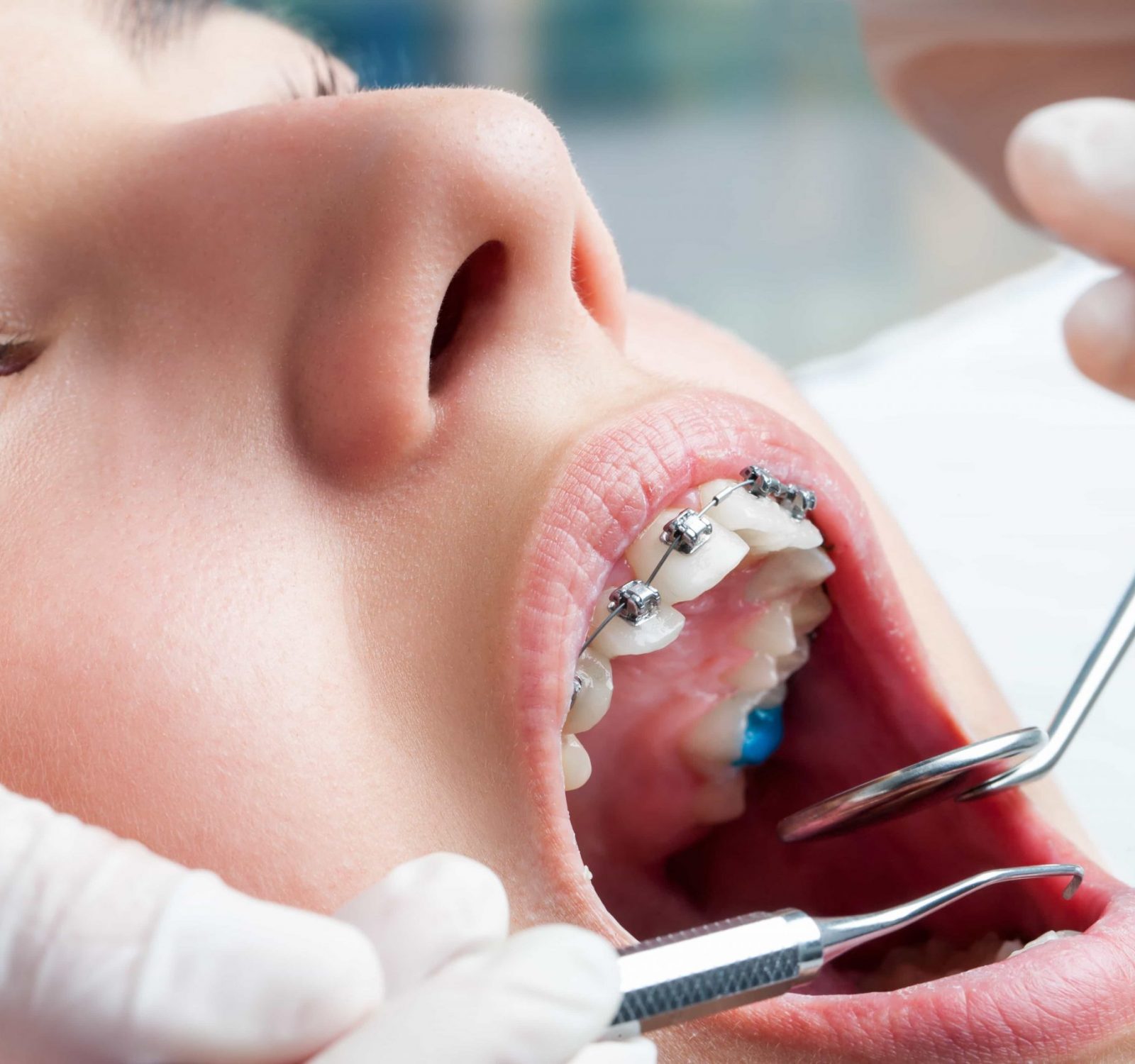 dentist inspecting teeth with braces